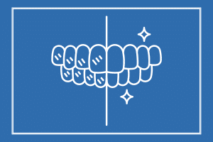 Teeth Whitening