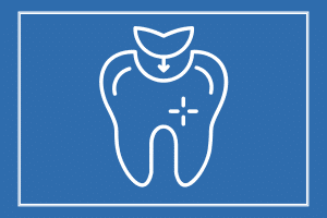 Tooth Colored Fillings