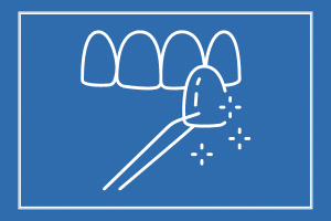 Dental Veneers